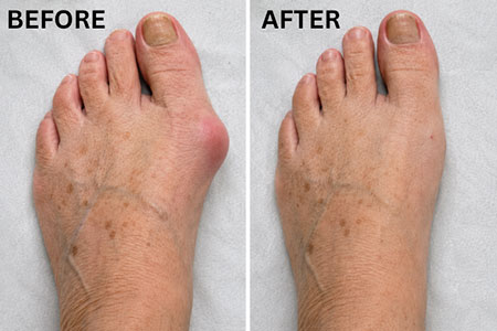 keyhole bunion surgery before and after