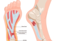 Plantar Fasciitis and a Podiatrist’s Role in Finding Relief