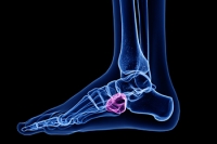The Cuboid Bone and Cuboid Syndrome